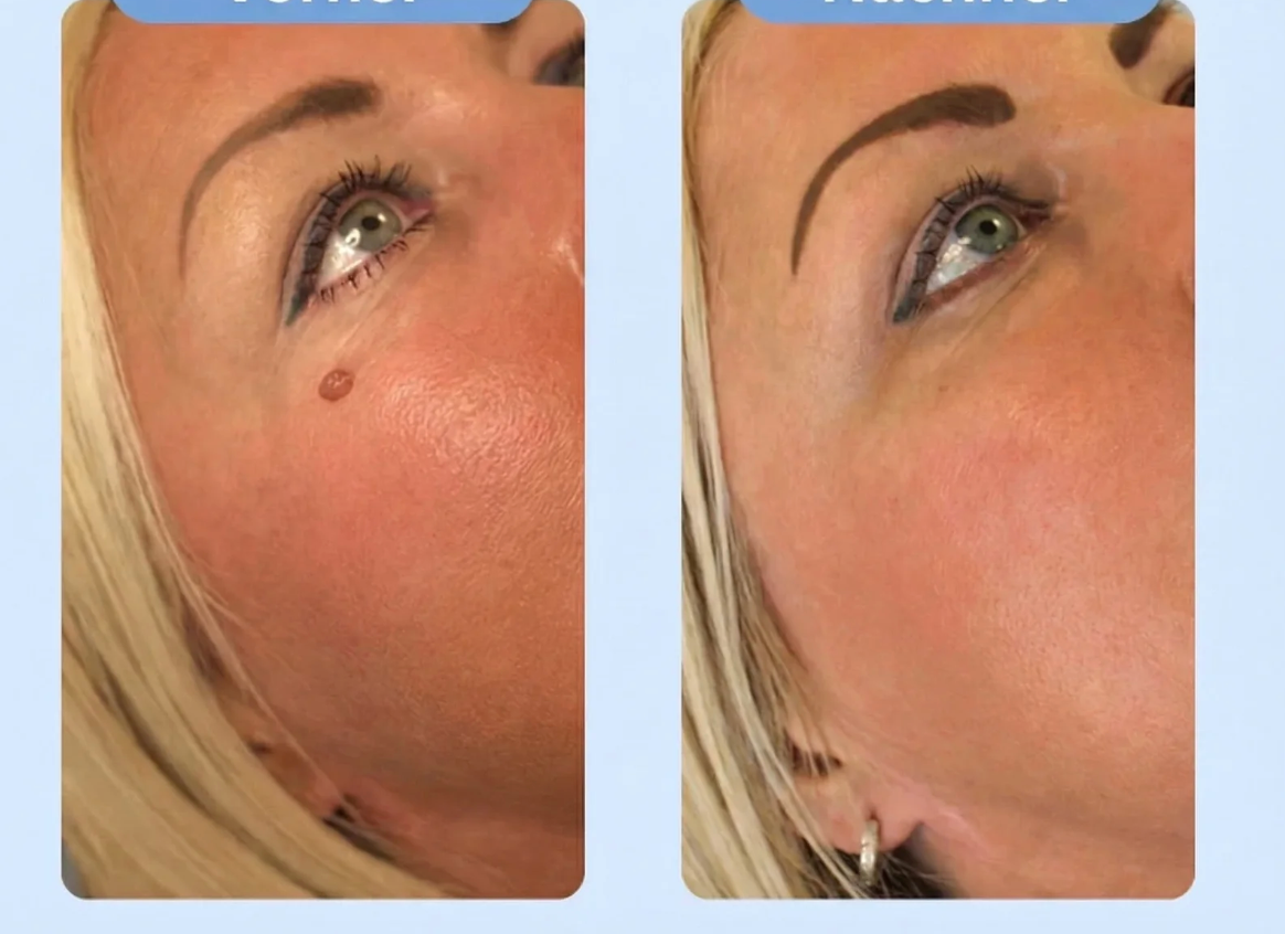 DermaEase™ Precision Skin Tag Remover – Clinically Inspired