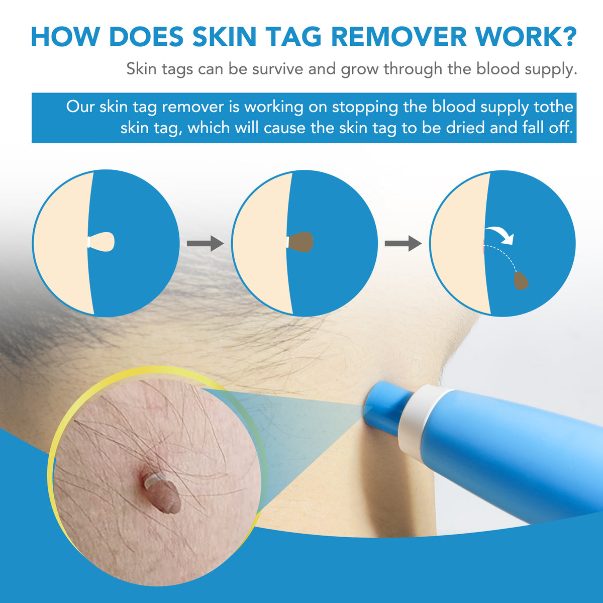 DermaEase™ Precision Skin Tag Remover – Clinically Inspired