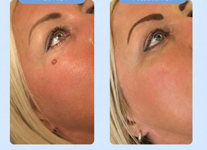 DermaEase™ Precision Skin Tag Remover – Clinically Inspired